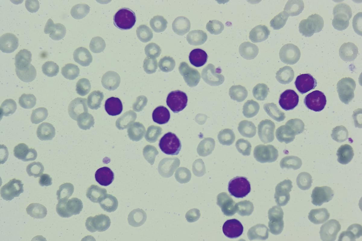 Зрелые лимфоциты в мазке крови. Источник: Alparslan Merdin et al. / Clinical Case Reports, 2017