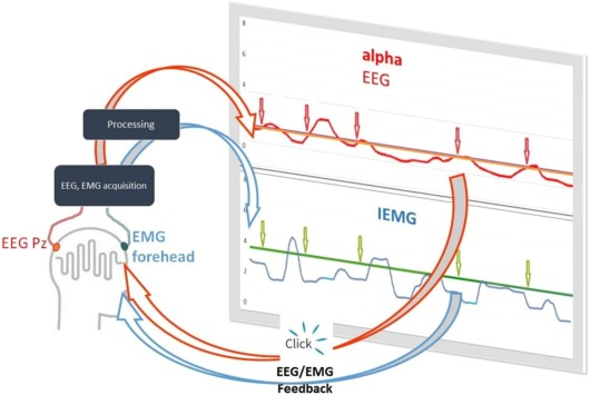 Схема процедуры нейробиоуправления с одновременным усилением альфа-ритма ЭЭГ и снижением ЭМГ; Pz — срединная точка теменной области. На верхнем экране красная линия трассировки - динамика изменений величины альфа-2, на нижнем экране синяя линия трассировки - динамика изменений интегральной мощности IEMG лба (каждая точка = 200 мс), прямые линии - пороговые значения, равные среднему значению альфа (красная линия) и IEMG (зеленая линия) в предтренировочный период, стрелками обозначены моменты появления сигнала обратной связи в виде звука щелчка, когда одновременно альфа-ЭЭГ поднимается выше порога (красные стрелки) и IEMG снижается ниже порога (зеленые стрелки )